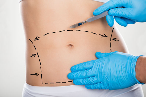 Abdominoplastik Kassel